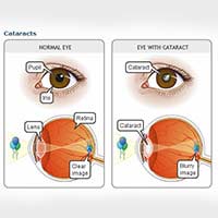 Benefits & Risks Of Cataract Surgery