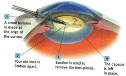 Micro-incision Cataract Surgery Phacoemulsification