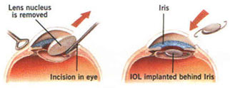Extra- Capsular Cataract Extraction ECCE - a conventional technique