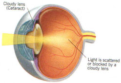 Eye with Cataract