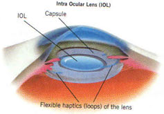 Micro-incision Cataract Surgery Phacoemulsification